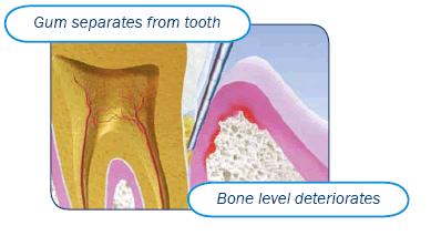 Advanced periodontitis cartoon